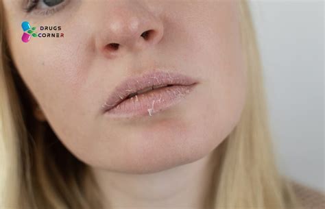 Why Your Eczema on Lips May Worsen and You Don’t Even Know