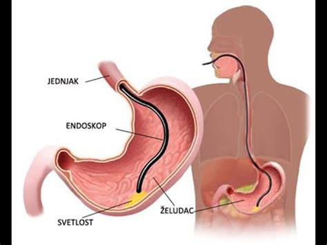 Upper gastrointestinal endoscopy/Gastroscopy/ Gastritis/Gastric ulcer ...