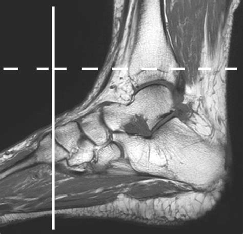 Plantar Tendons of the Foot: MR Imaging and US | RadioGraphics