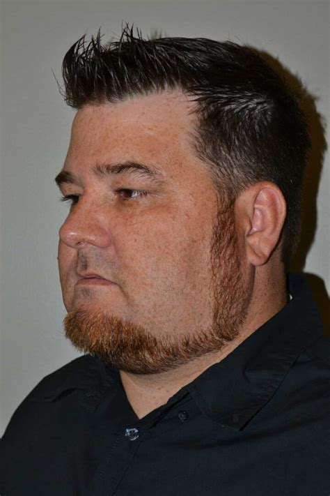 maxillary  mandibular osteotomy aspire surgical