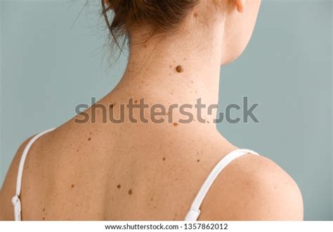 3,047 Moles Back Images, Stock Photos & Vectors | Shutterstock