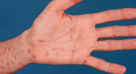maculopapular rash syphilis