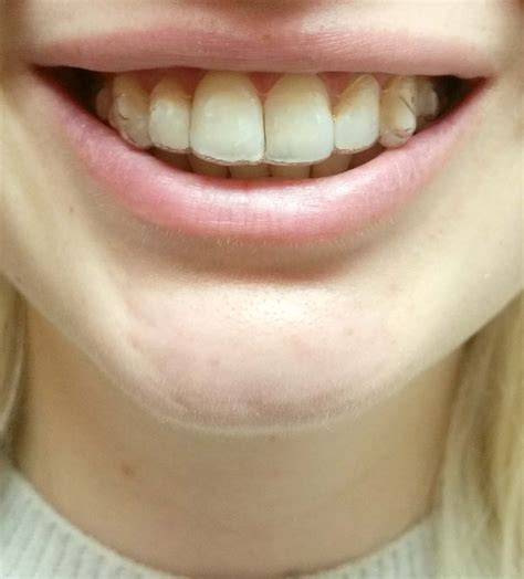 Halbzeit! Die ersten 3 Monate mit Invisalign