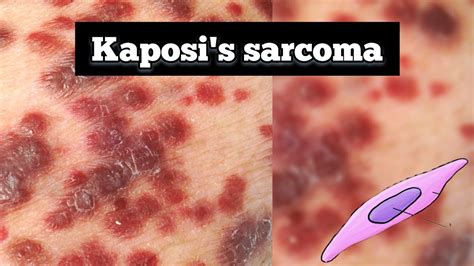 Kaposi Sarcoma: Diagnosis and Treatment