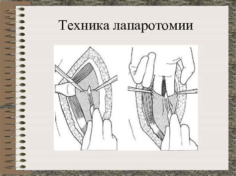 ЛАПАРОТОМИИ Виды лапаротомий Продольные Косые Переменные Поперечные
