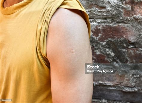 Bcg Or Tb Vaccine Scar Mark At The Arm Of Asian Man Stock Photo ...