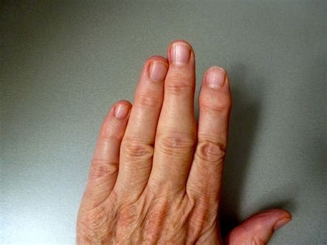 Arthritis Bumps On Finger Joints