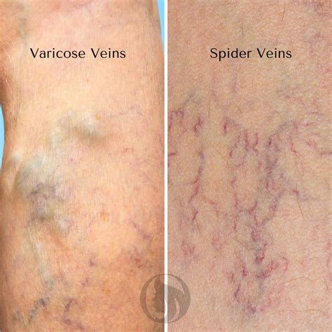 understanding   types  varicose veins goulart salon