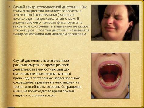 Оромандибулярная дистония - презентация онлайн