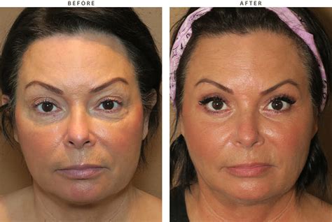 mid face lift    pictures dr turowski plastic