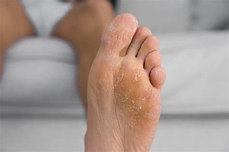 Descamação Do Pé - Close-up de descamação e pé rachado infecção fúngica ou dermatite de ...