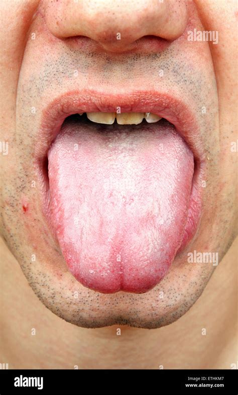 Fungal Infection On Tongue