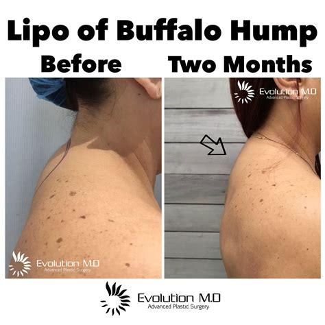 Cushing Syndrome Buffalo Hump at Betty Love blog