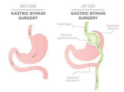 Laparoscopic Rny Gastric Bypass Treatment Service in Ramgopalpet, Secunderabad, Sunshine ...