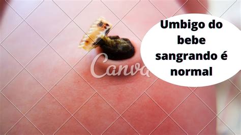 É Normal O Umbigo Do Rn Sangrar