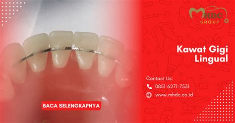 mengenal kawat gigi lingual behel lingual  keunggulannya