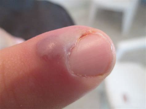How To Fix Ingrown Thumb Nail at Jesse Lombard blog