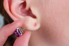 earring back stuck in earlobe how to remove at home