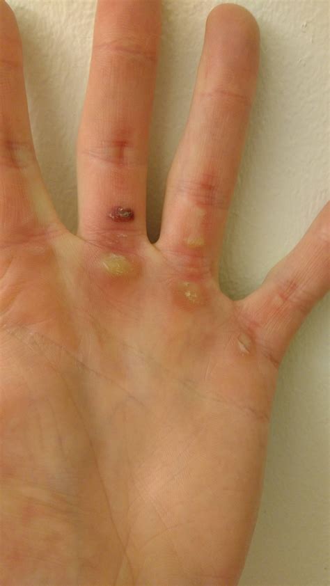 Bad calluses. Do i need to take a break from deadlifting? : Fitness
