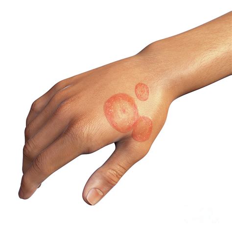 Ringworm #16 Photograph by Kateryna Kon/science Photo Library - Pixels
