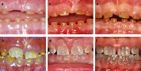 Why Is My Tooth Turning Grey?