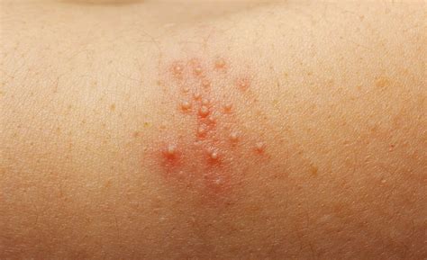 Prickly heat (sweat rash) | Family Health Diary