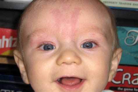 Rash On Baby Forehead