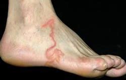 Signs and Symptoms of Worm Infestation
