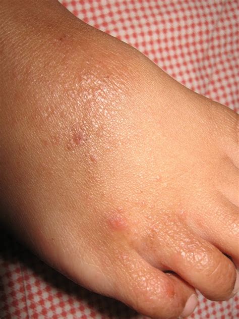 ubat luka celah peha jurupulih p