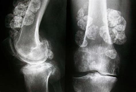 synovial chondromatosis bone  spine