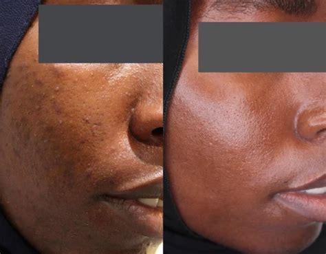 Best PIH post inflammatory hyperpigmentation treatments