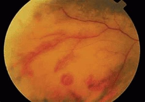 Acute Retinal Necrosis and Progressive Outer Retinal Necrosis Syndromes ...