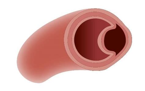 Aortic Intramural Hematoma. Image with permission by Deutsches... | Download Scientific Diagram