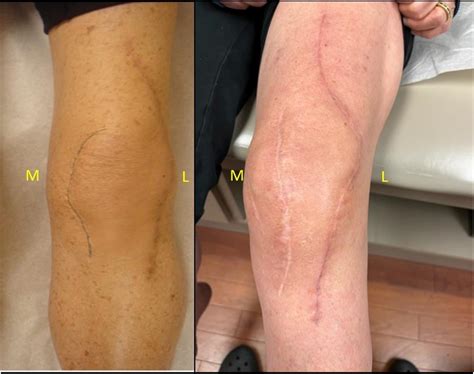 incisional management   multiply operated total knee arthroplasty