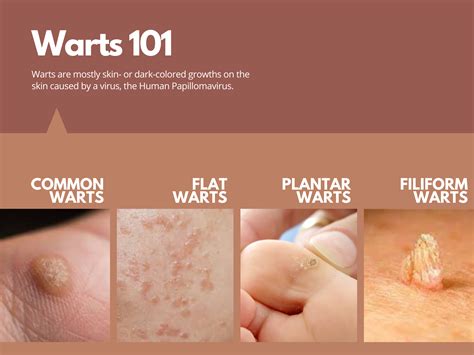 How To Remove Warts On Face