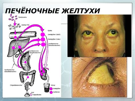 Патология печени. Причины печеночно-клеточной недостаточности - online ...