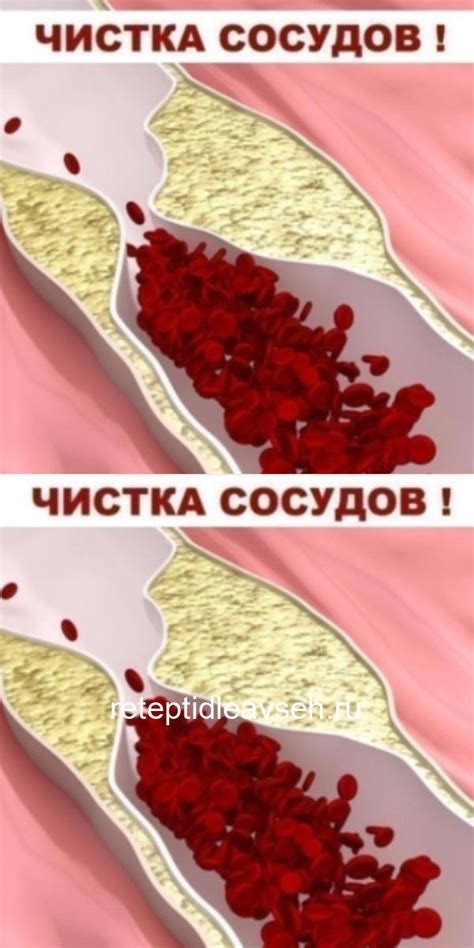 ЧИСТКА СОСУДОВ!