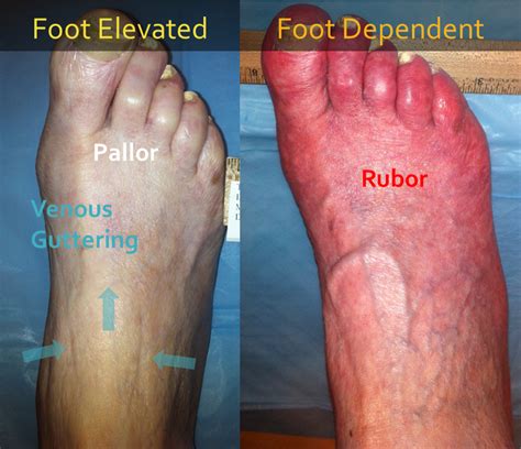 clinical evaluation   foot  peripheral arterial diseasemichael