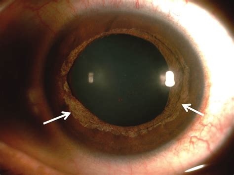 slit lamp image  diffuse illumination   left eye