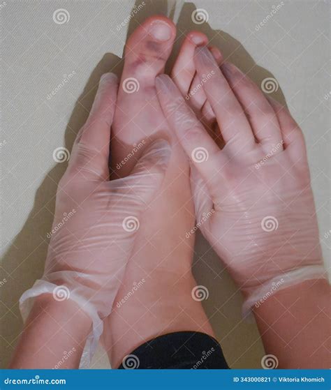 Purple Bruise On Toenail, Injured Foot Stock Image | CartoonDealer.com