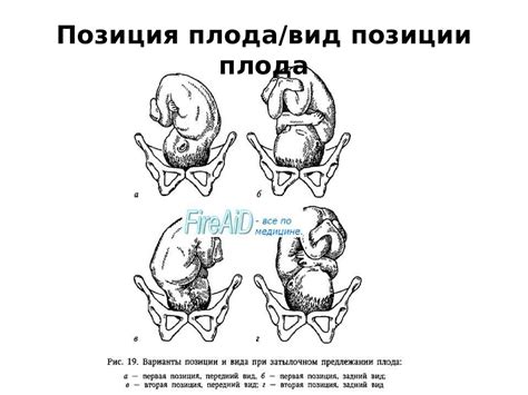 Биомеханизм родов в переднем и заднем видах затылочного вставления ...