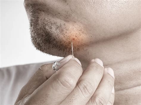 ingrown hairs and laser hair removal 12