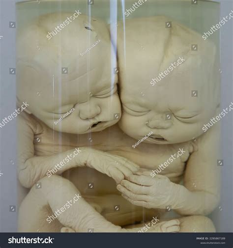 Siamese Twins