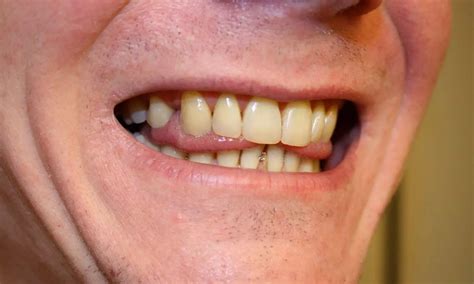 routine premolar extraction  part  orthodontic treatment  impact