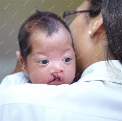 Crianças Com Lábio Leporino - Lábio leporino médico e um pediatra com um bebê no hospital para ...
