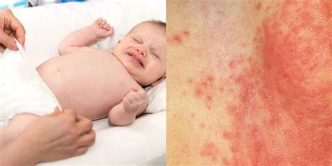 ruam merah  bayi akibat kesalahan  penggunaan lampin