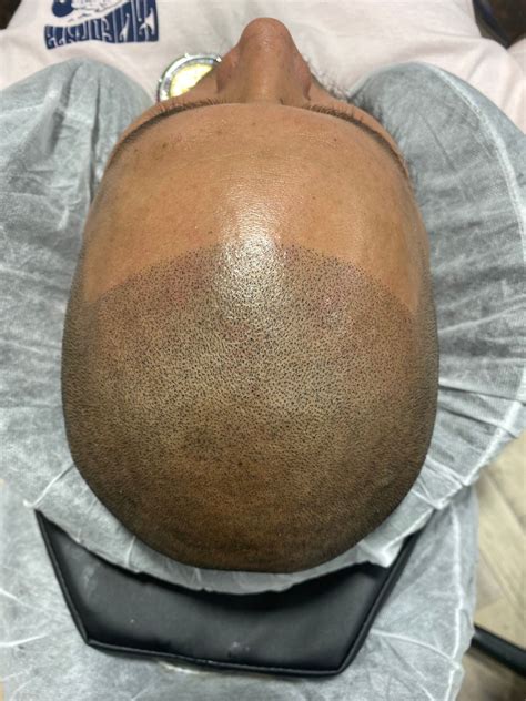 Scalp Micropigmentation Near Tampa Airport