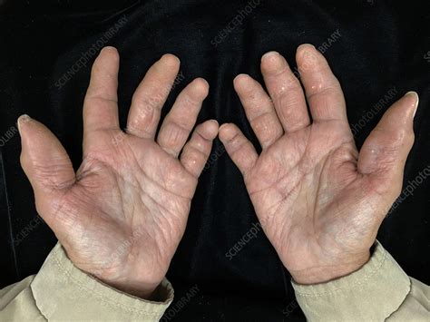 scleroderma stock image  science photo library