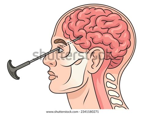 426 Lobotomy Images, Stock Photos, 3D objects, & Vectors | Shutterstock