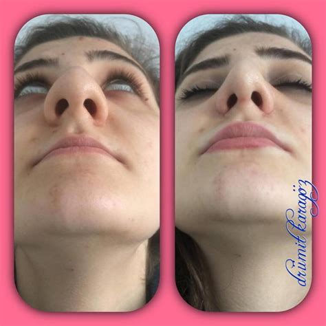 Bulbous Rhinoplasty Before And After (2) » Rhinoplasty: Cost, Pics ...